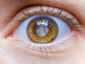 Como Fazer Cirurgia de Catarata em Curitiba